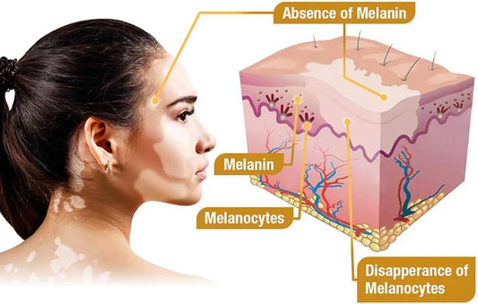 VitiGO Bee Venom Correcting Cream – Vitiligo & Skin Pigmentation Treatment (20g)