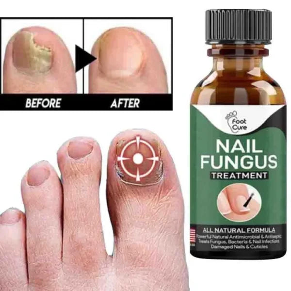 Nail Fungus Treatment