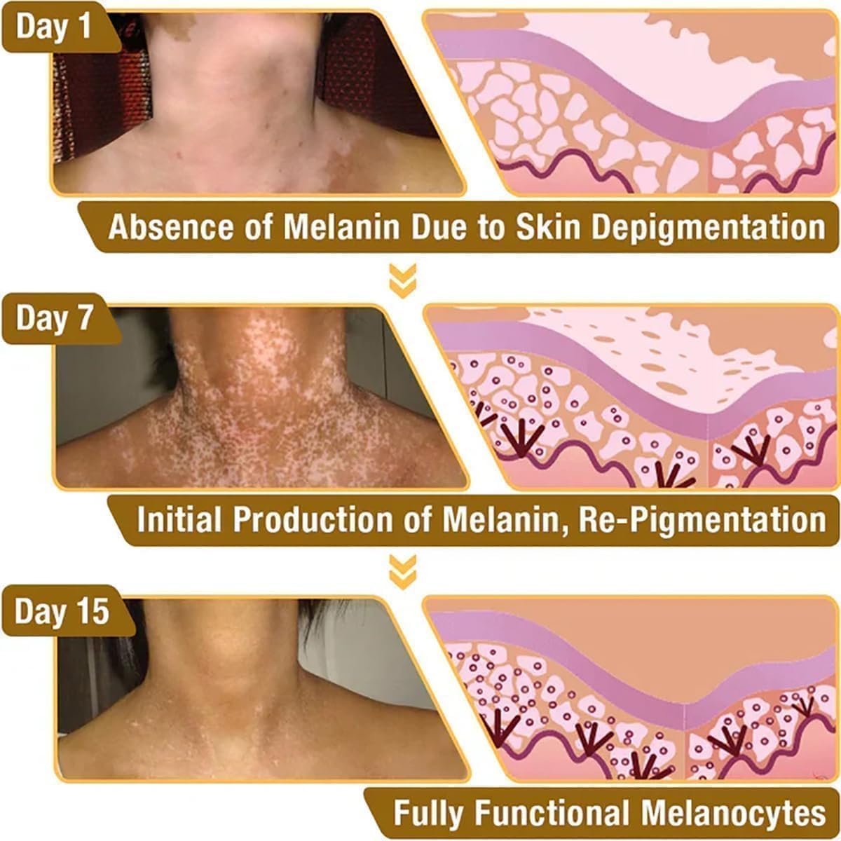 VitiGO Bee Venom Correcting Cream – Vitiligo & Skin Pigmentation Treatment (20g)