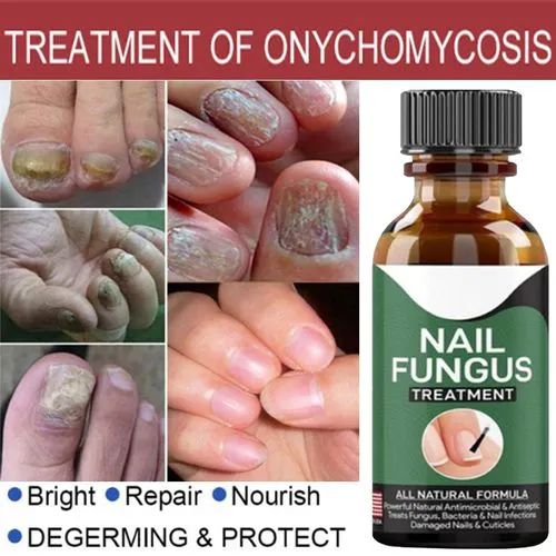Nail Fungus Treatment