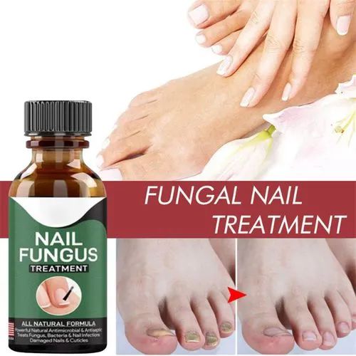 Nail Fungus Treatment