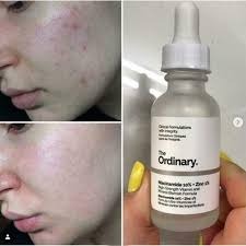 The Ordinary Niacinamide 10% + Zinc 1 % – 20 Ml |oil Control, Pore Minimizing.